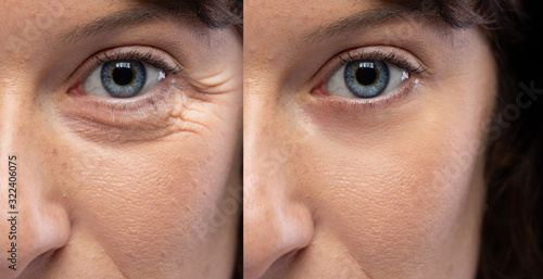 Woman eyes before and after an anti age treatment for wrinkles and crow's feet photo
