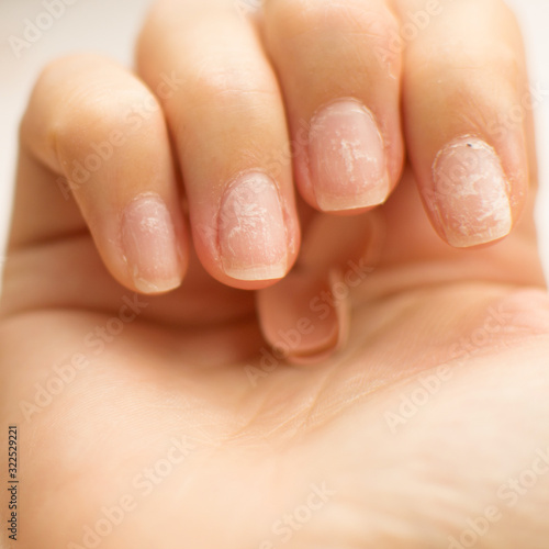 Slika na platnu Close up woman nails after bad manicure on white background