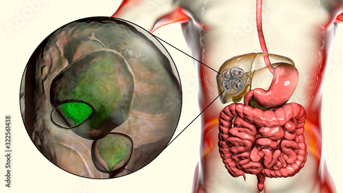 Hydatid cyst of Echinococcus multilocularis photo