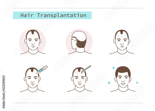 Man Character Losing Hair and Receiving Treatment Procedures against Baldness. Prp Injections. Bald Before and After.  Hair Transplantation Surgery Concept. Flat Vector Illustration and Icons set.