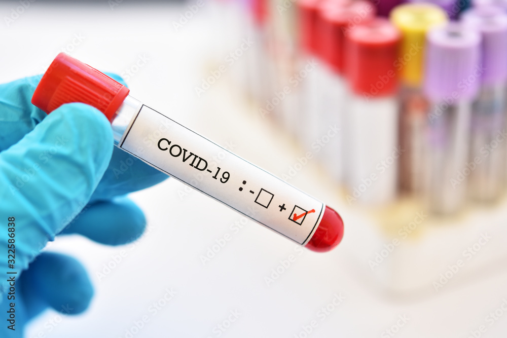 Obraz premium Blood sample tube positive with COVID-19 or novel coronavirus 2019 found in Wuhan, China