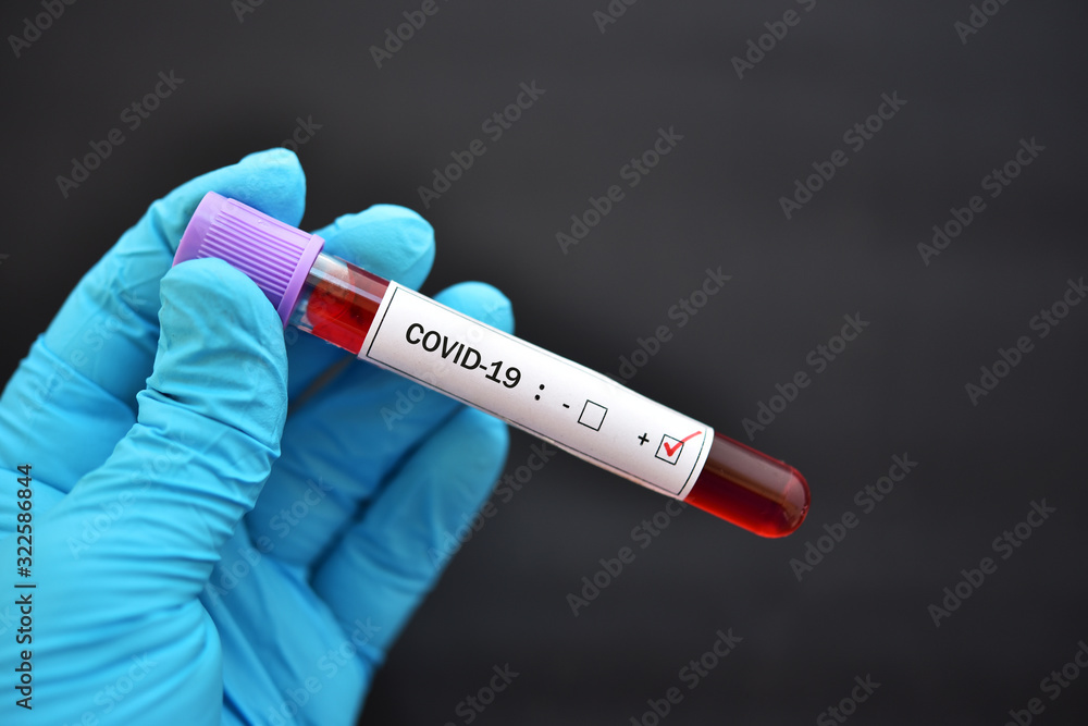 Obraz premium Blood sample tube positive with COVID-19 or novel coronavirus 2019 found in Wuhan, China