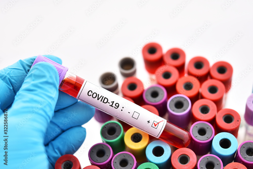 Fototapeta premium Blood sample tube positive with COVID-19 or novel coronavirus 2019 found in Wuhan, China