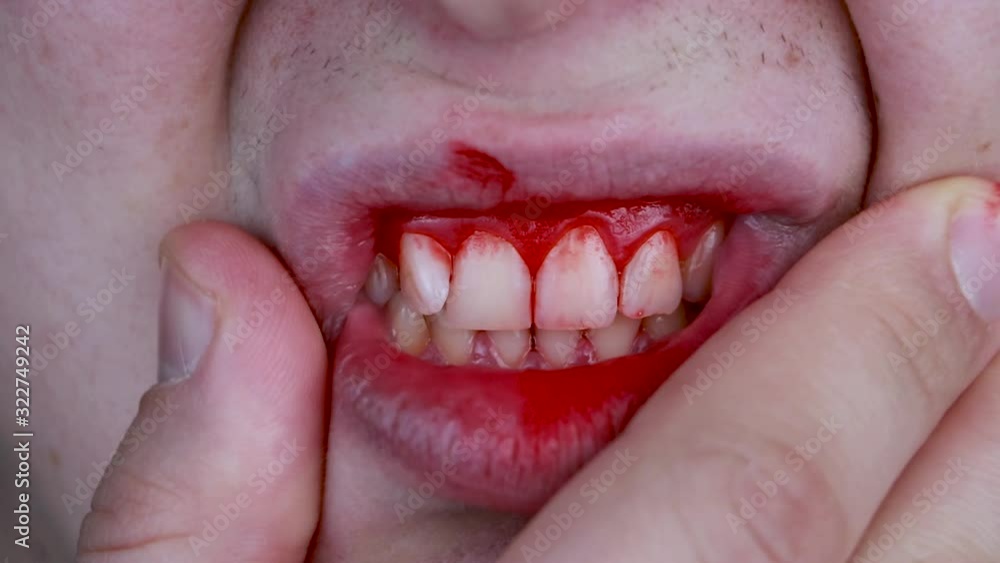 Gum bleeding and inflammation close up. A man examined by a dentist