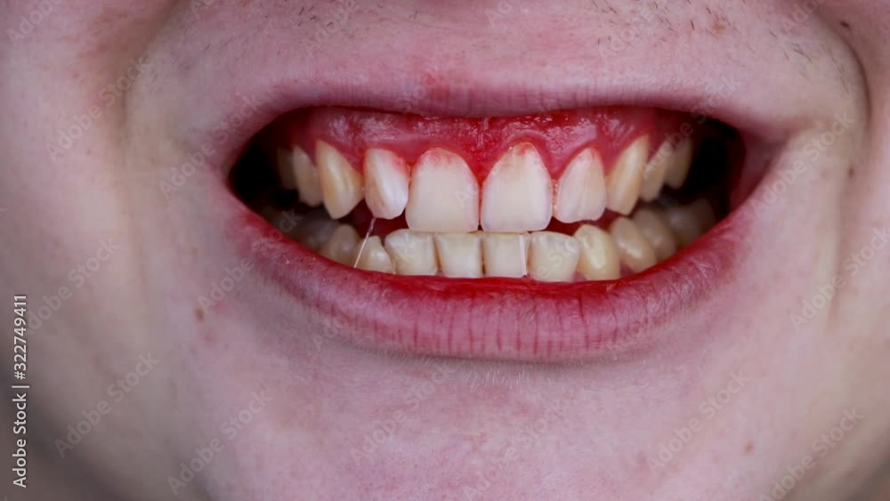 Gum bleeding and inflammation close up. A man examined by a dentist