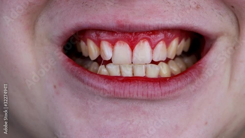 Gum bleeding and inflammation close up. A man examined by a dentist. The diagnosis of gingivitis photo