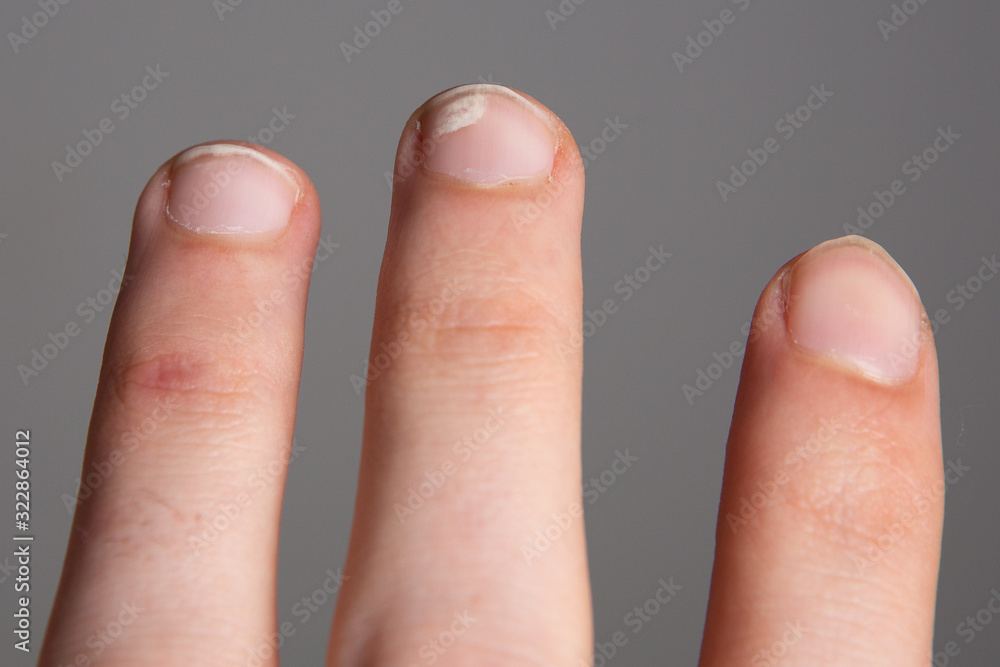 Leukonychia, white spots on the nails. Calcium and vitamin deficiency  concept Stock Photo | Adobe Stock