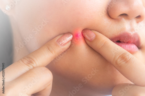 a girl is squeezing an acne on her face by her index fingers,woman squeezes acne on the face of beauty.