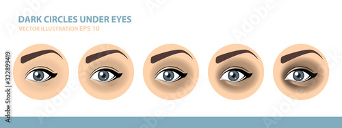 Dark Circles Under Eyes. Female Eye. Vector Illustration