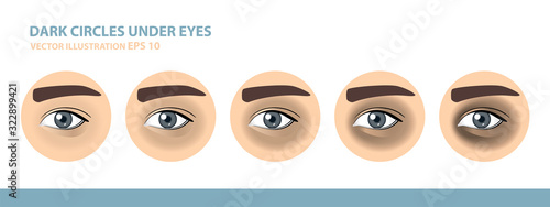 Dark Circles Under Eyes. Male Eye. Vector Illustration