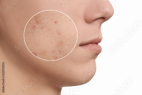 Teenage boy with acne problem on white background, closeup