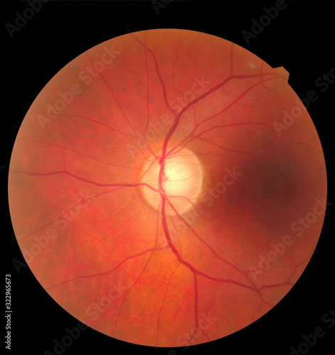 Human eye anatomy taking images with Mydriatic Retinal cameras. Examination of the eye, diabetic retinopathy, ARMD photo