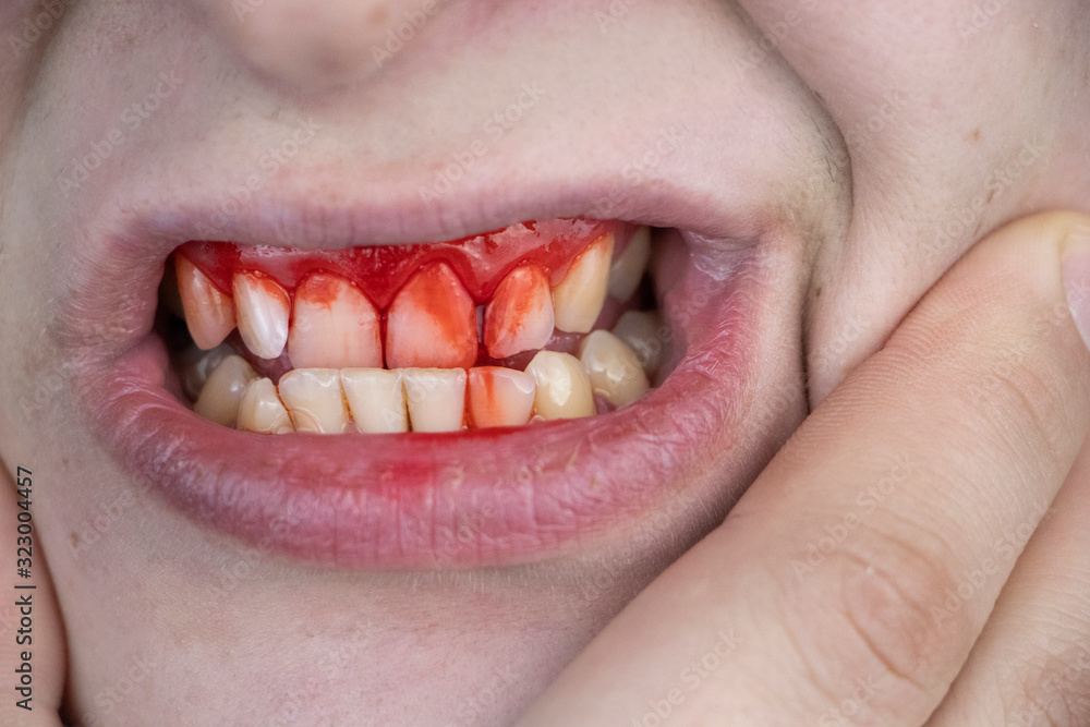 Fotka „The man has blood on his teeth, severe bleeding of the gums