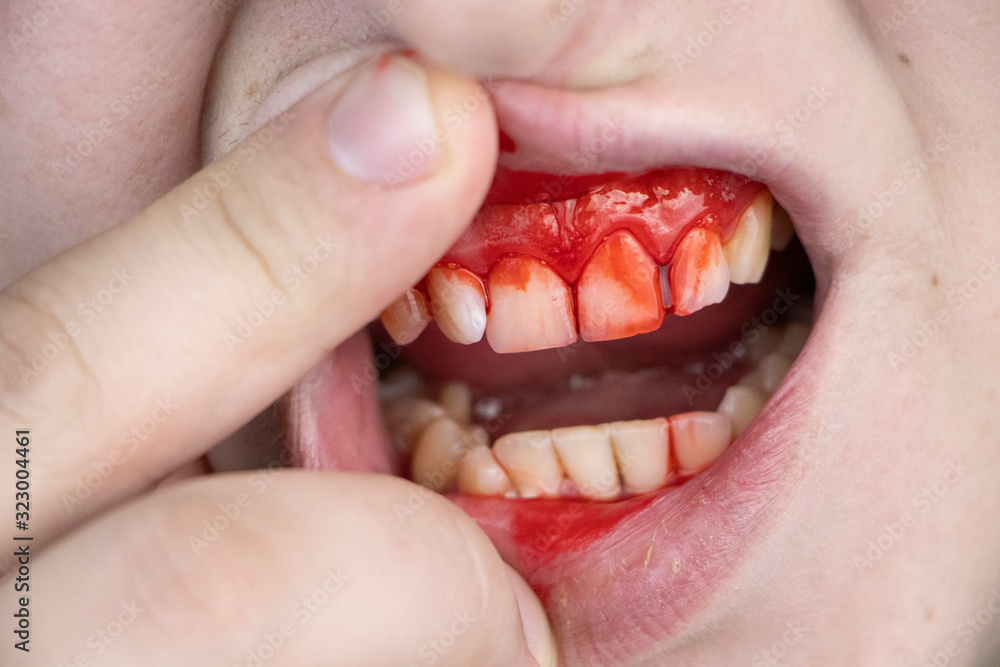 The man has blood on his teeth, severe bleeding of the gums after a