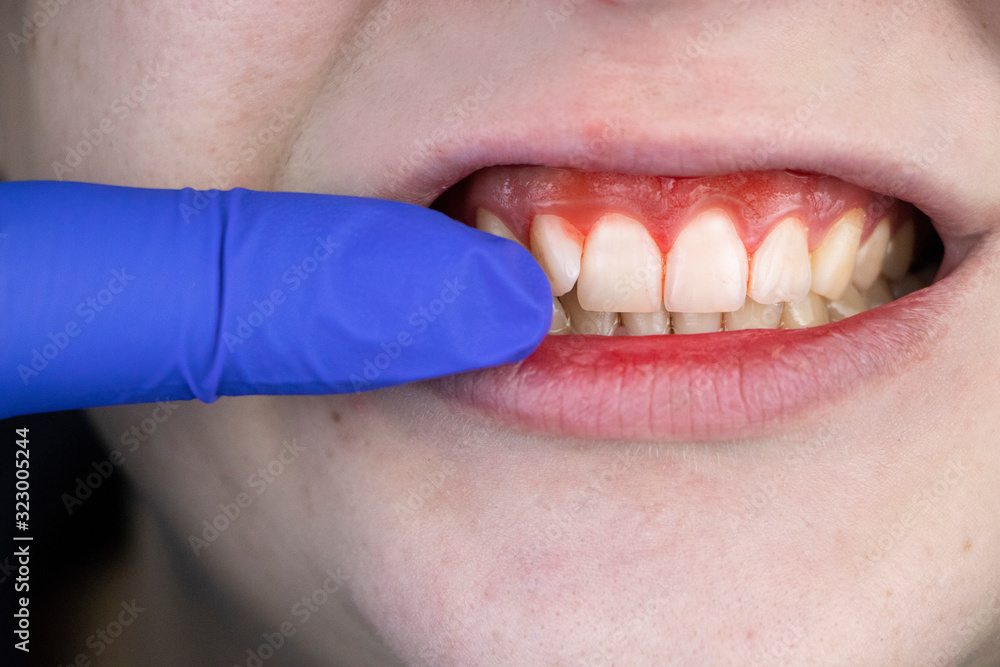 Fototapeta premium Gum bleeding and inflammation close up. A man examined by a dentist. The diagnosis of gingivitis