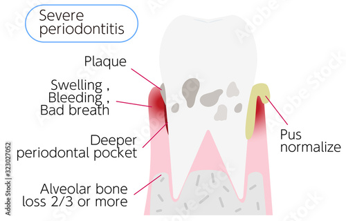 歯周病の進行段階別イラスト：重度歯周炎