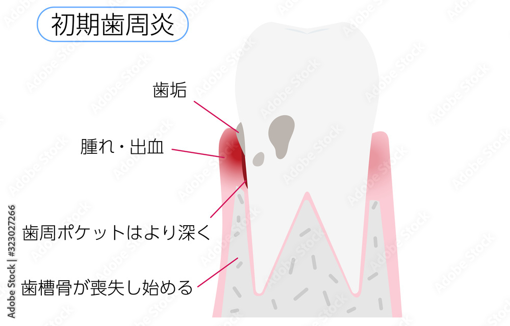 歯周病の進行段階別イラスト:初期歯周炎 Stock Vector | Adobe Stock