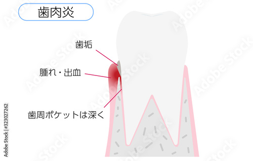 歯周病の進行段階別イラスト：歯肉炎