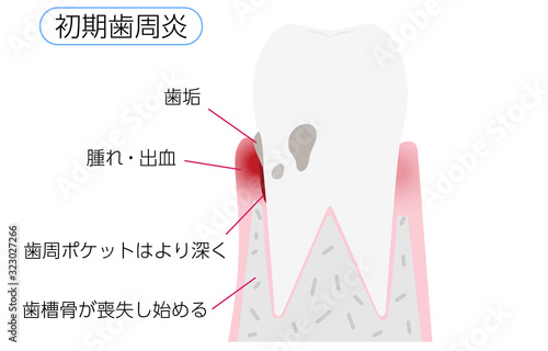 歯周病の進行段階別イラスト：初期歯周炎