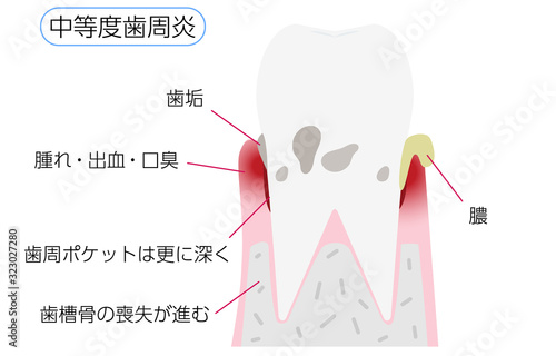 歯周病の進行段階別イラスト：中等度歯周炎