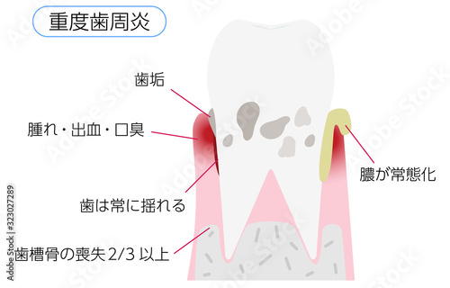 歯周病の進行段階別イラスト：重度歯周炎