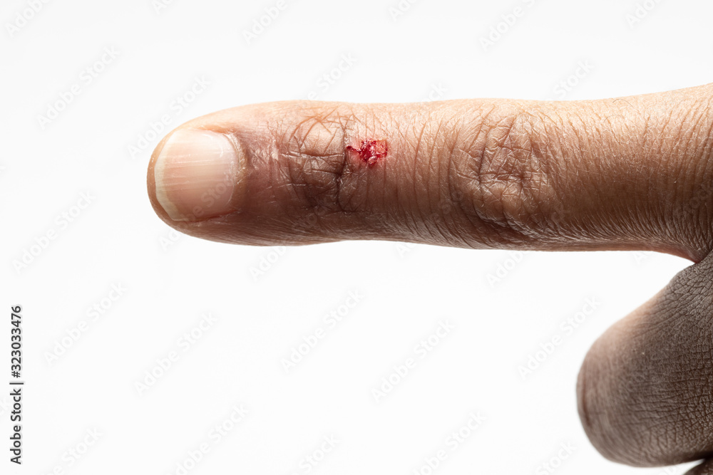 Obraz na plátně swelling of the finger and hyperkeratinization of the skin: concept of skin heal