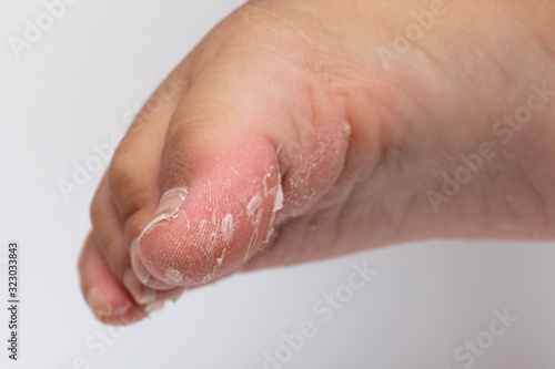 blisters and skin exfoliation: concept of foot health © Alessandro Grandini