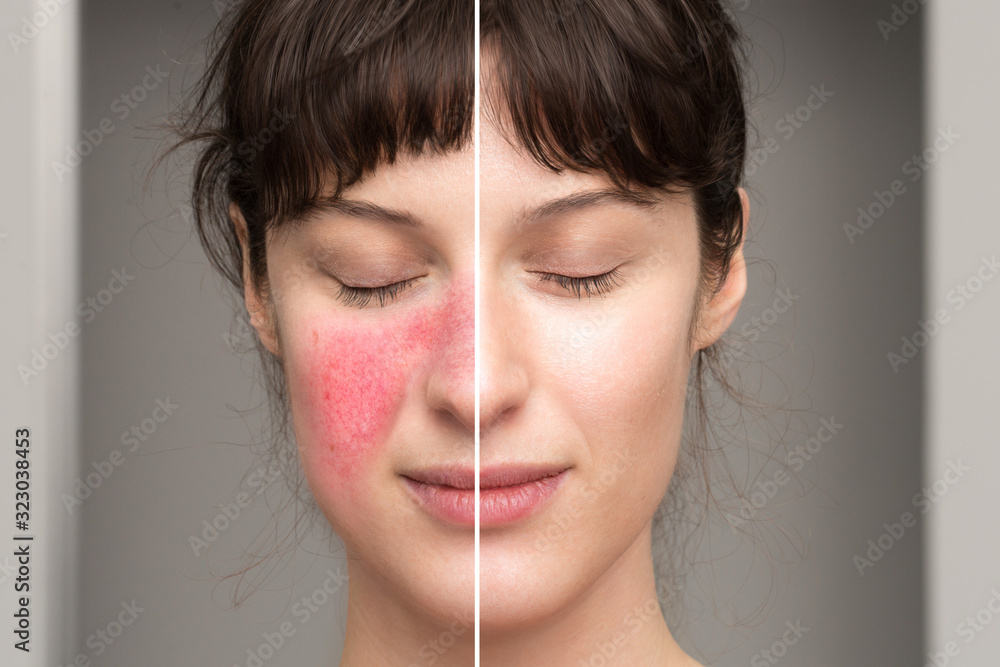 Φωτογραφία signs and symptoms of rosacea: natural cures in the treatment of skin disorders