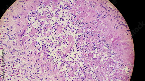 Basidiobolus fungal hyphae in colon biopsy specimen photo