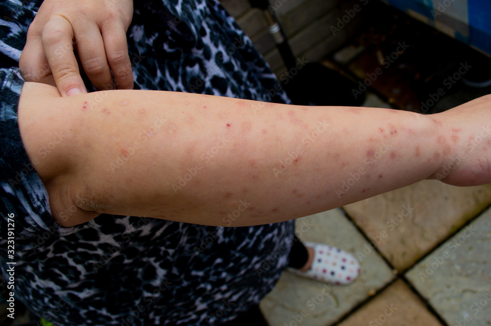 Bed bug bites, swelling and scars in multiple locations on the skin of a females arm from a