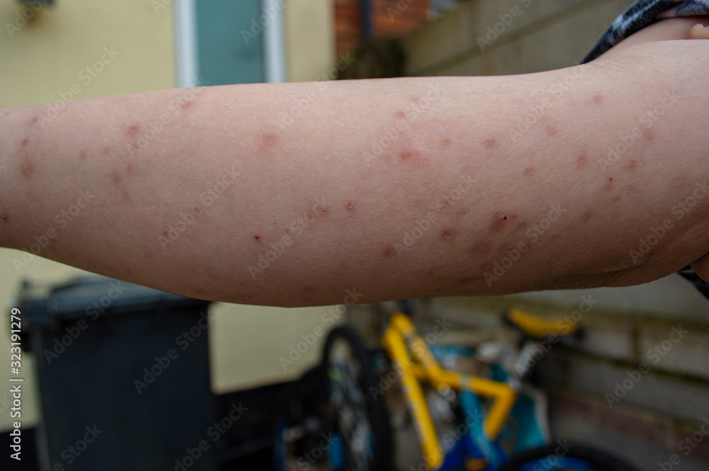 Stockfoto Bed bug bites, swelling and scars in multiple locations on the  skin of a females arm from a residential property infested with common  bedbugs, Cimex lectularius a biting insect parasite in