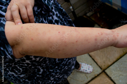 Bed bug bites, swelling and scars in multiple locations on the skin of a females arm from a residential property infested with common bedbugs, Cimex lectularius a biting insect parasite in the bedroom