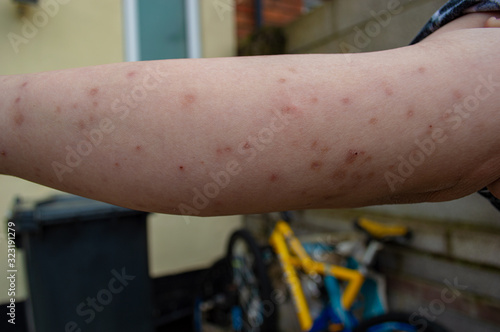 Bed bug bites, swelling and scars in multiple locations on the skin of a females arm from a residential property infested with common bedbugs, Cimex lectularius a biting insect parasite in the bedroom