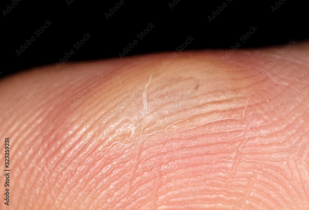 Fototapeta premium Corn on a finger isolated on a black