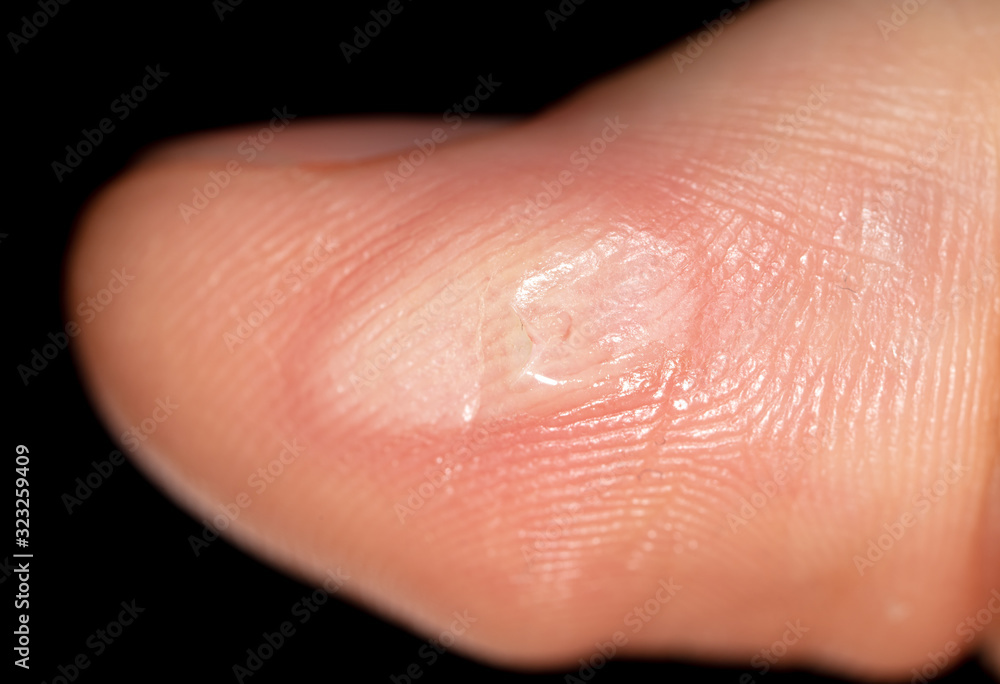 Corn on a finger isolated on a black Corn on a finger isolated on a black