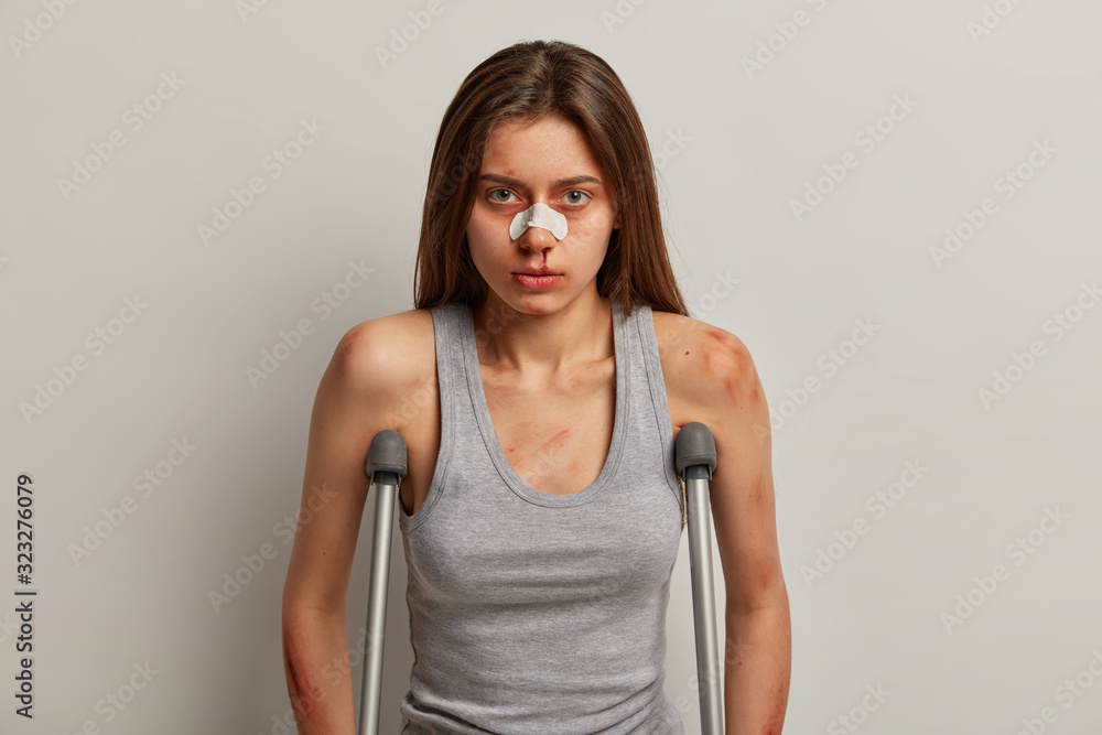 Upset serious bruised woman fell and got bone fracture, has awful accident during dangerous travel, stands on crutches, applies bandage on damaged nose, isolated over grey background. Insurance case