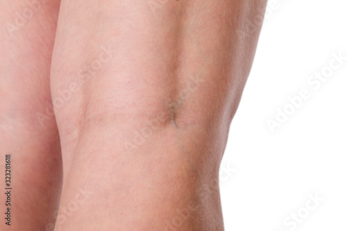 Varicose veins under the skin of a woman on a white background