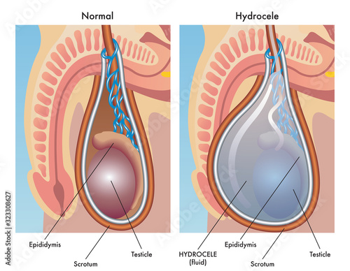 Medical illustration of hydrocele in male testicles showing inflammation before and after.
