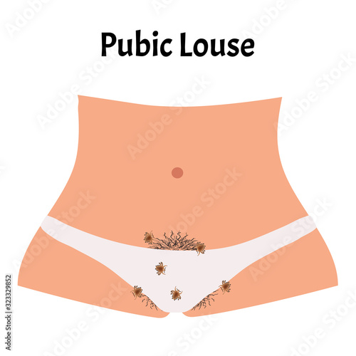 Parasitic diseases of Phthiriasis. Pediculosis pubis. Pubic lice structure. Sexually transmitted diseases. Infographics. Vector illustration on isolated background.