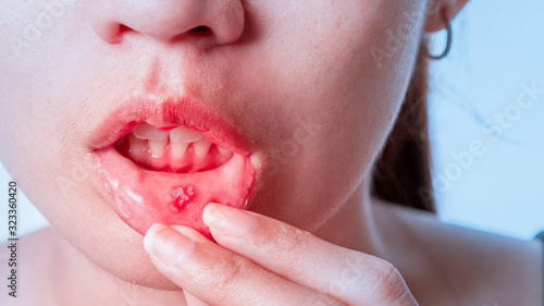 Asian women have aphthous ulcers on mouth on white background, selective focus.