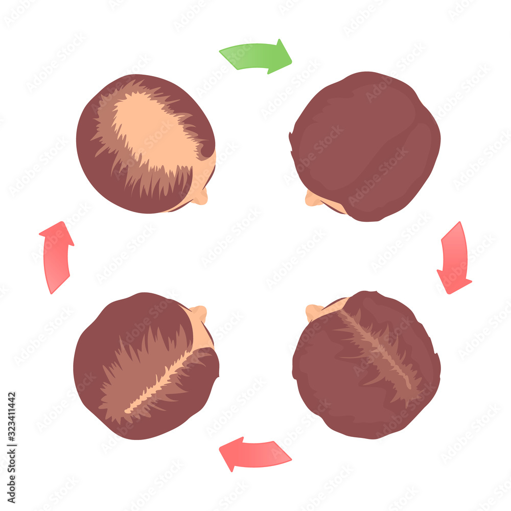 Stockvector Femalepattern hair loss 4 stages set with head in top view