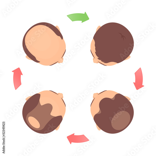 Male-pattern hair loss 4 stages set with head in top view. Classification of baldness in men in round chart with circular arrows. Androgenetic alopecia medical infographic. Vector illustration.