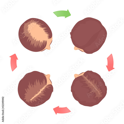 Female-pattern hair loss 4 stages set with head in top view. Classification of baldness in women in round chart with circular arrows. Androgenetic alopecia medical infographic. Vector illustration.