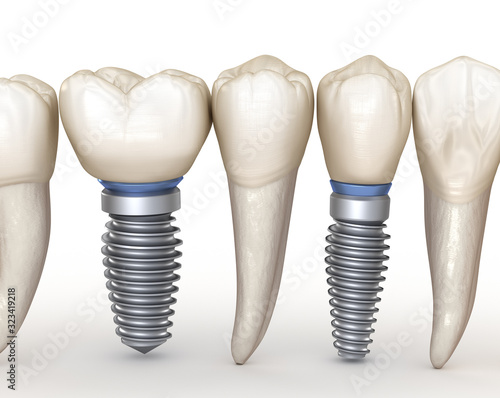 Dental Implants in line. 3D illustration concept of human teeth.