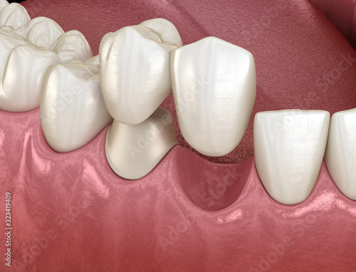 Photos Cantilever bridge made from ceramic, frontal tooth recovery