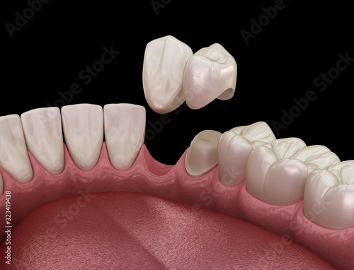 фотографія Cantilever bridge made from ceramic, frontal tooth recovery