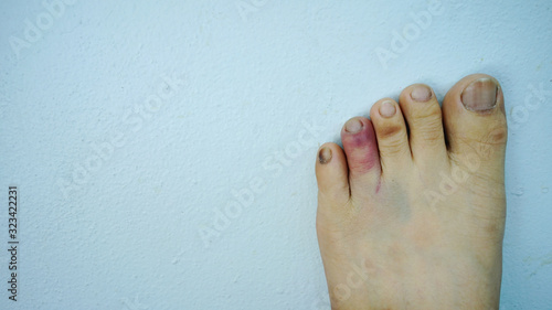  Repeated swelling in the toe Caused by accident 