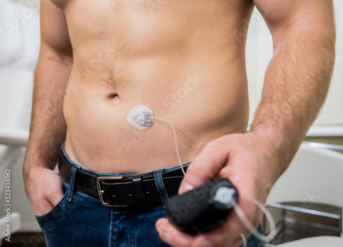 Diabetic man with an insulin pump connected in his abdomen 