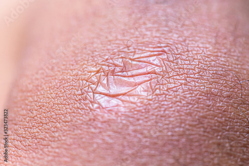 Close up of cyanotic keloid scar caused by surgery and suturing photo