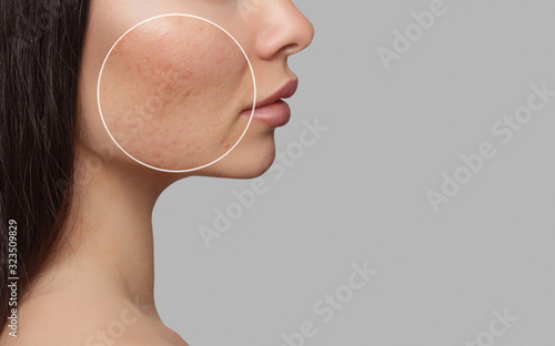 Fototapeta Photo before and after treatment for acne
